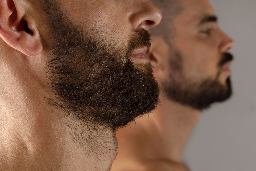 dhi Beard Transplant